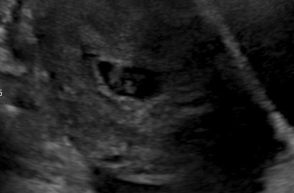 A 3D ultrasound image of a baby's face